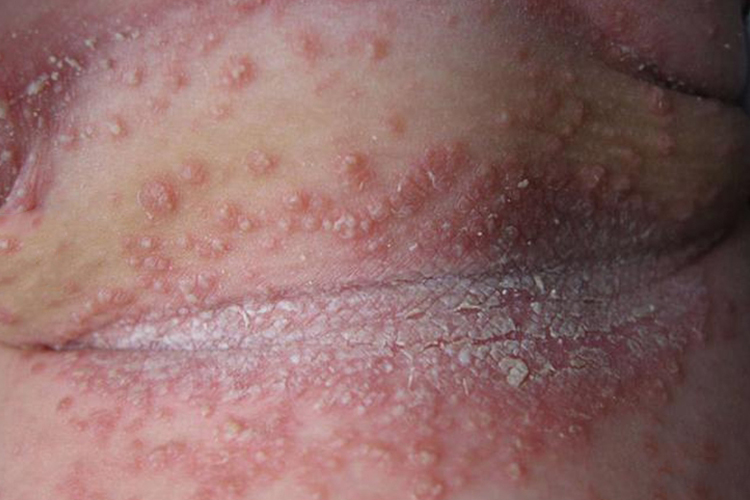 红斑丘疹糜烂图片