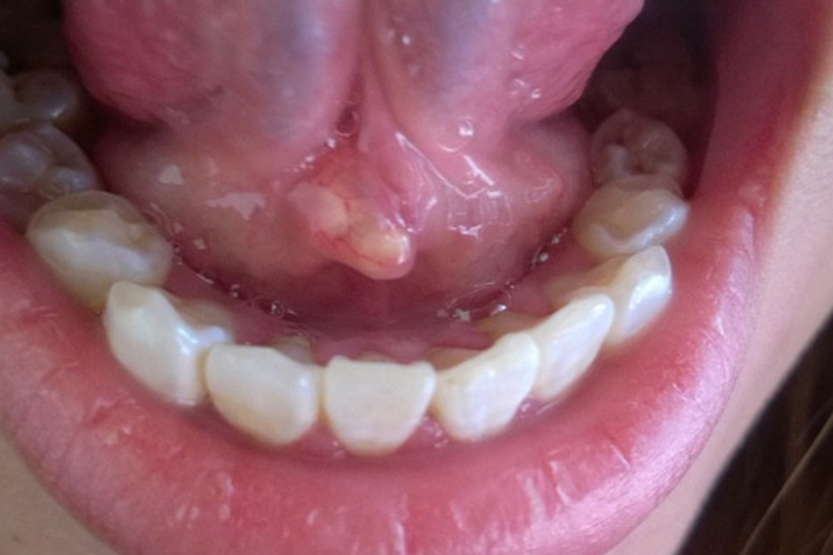 涎石病白色疙瘩图