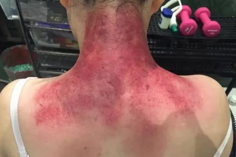 拔罐后皮肤颜色为鲜红色图 拔罐后皮肤颜色为鲜红色图