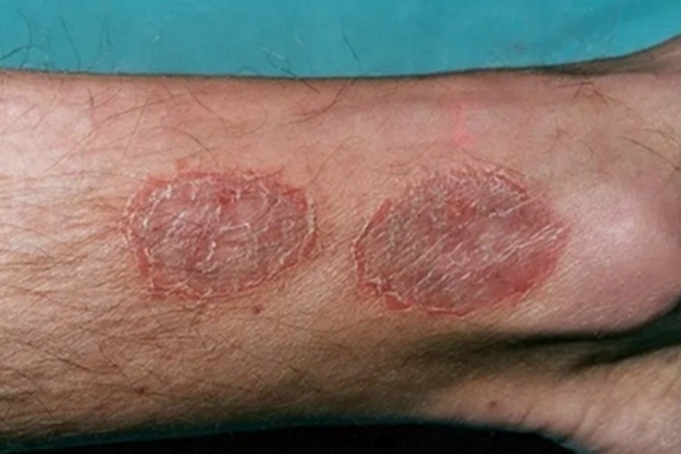钱币状湿疹小腿症状图