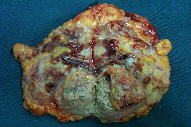 肾癌直接播散图