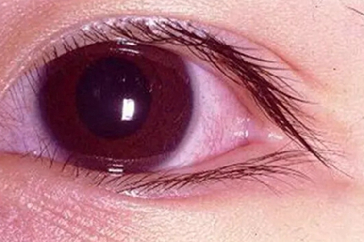 干燥综合征眼睛血丝图 干燥综合征眼睛血丝图