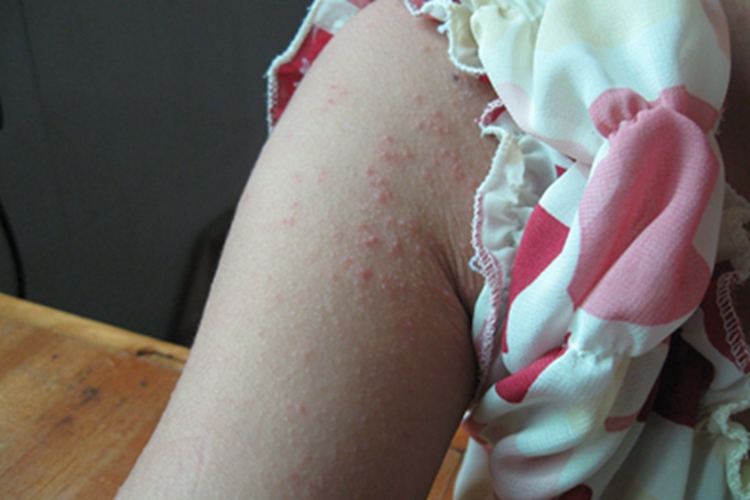 战壕热胳膊症状图 战壕热胳膊症状图