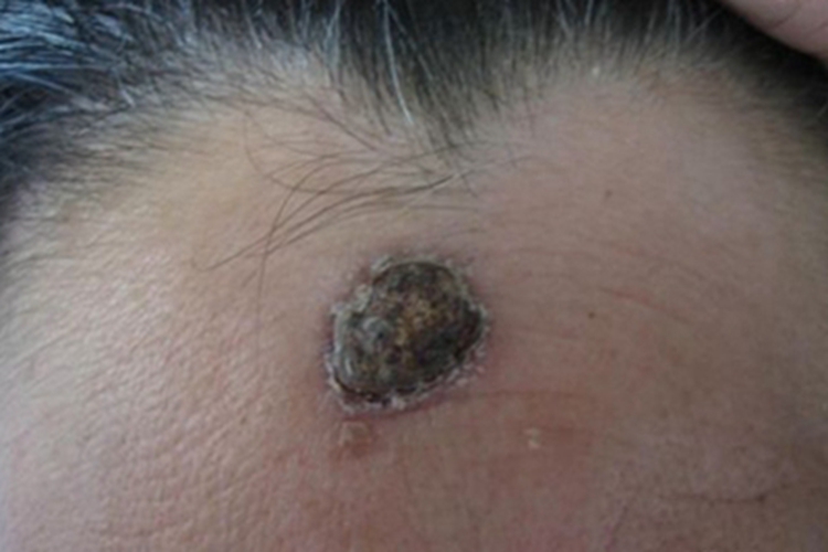 结节型基底细胞瘤前额症状图