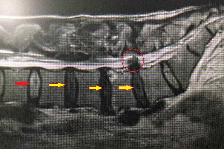 腰间盘外突影像图