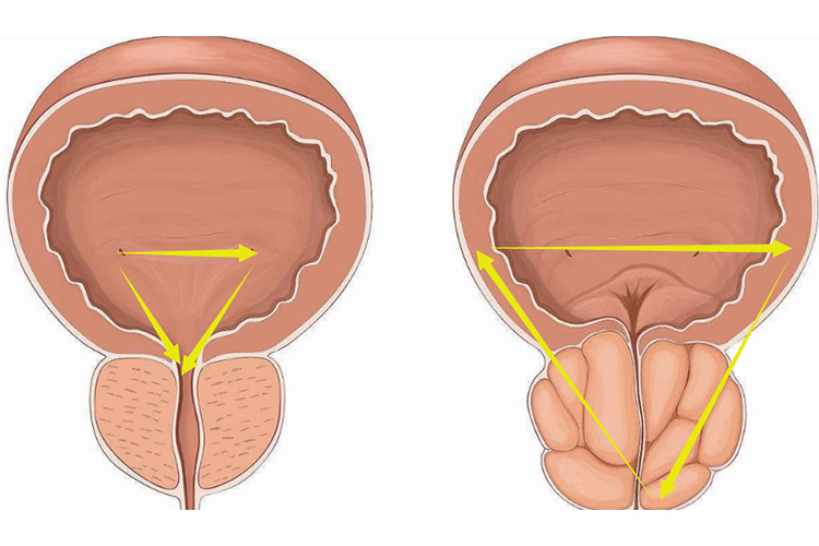 膀胱三角区位置图