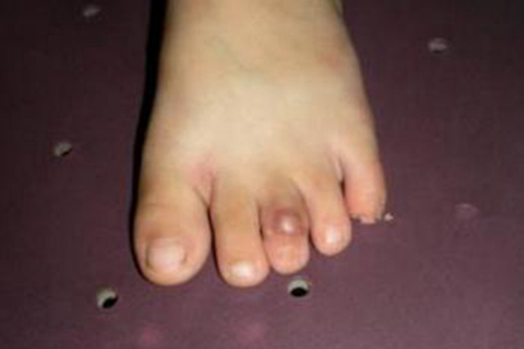 掌跖纤维瘤病脚趾肉球图 掌跖纤维瘤病脚趾肉球图