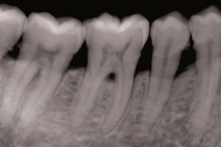 上颌前磨牙根尖片图 上颌前磨牙根尖片图