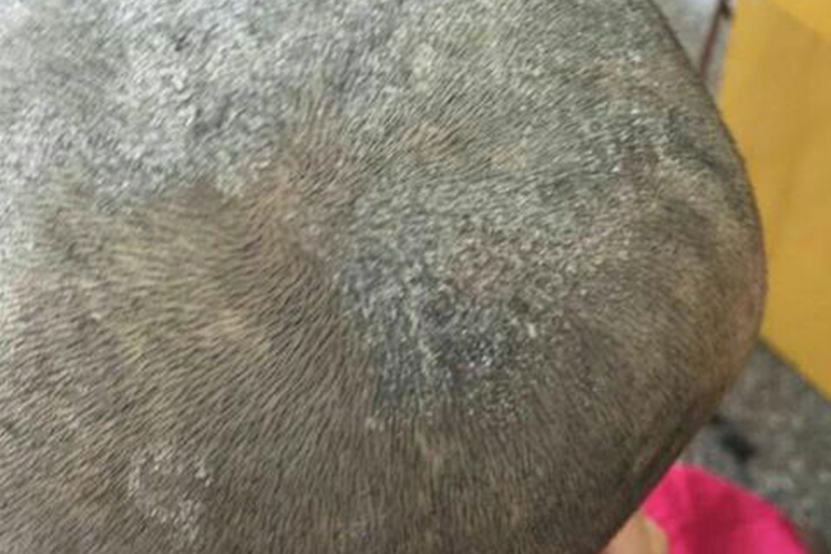 儿童头皮束发状干屑图