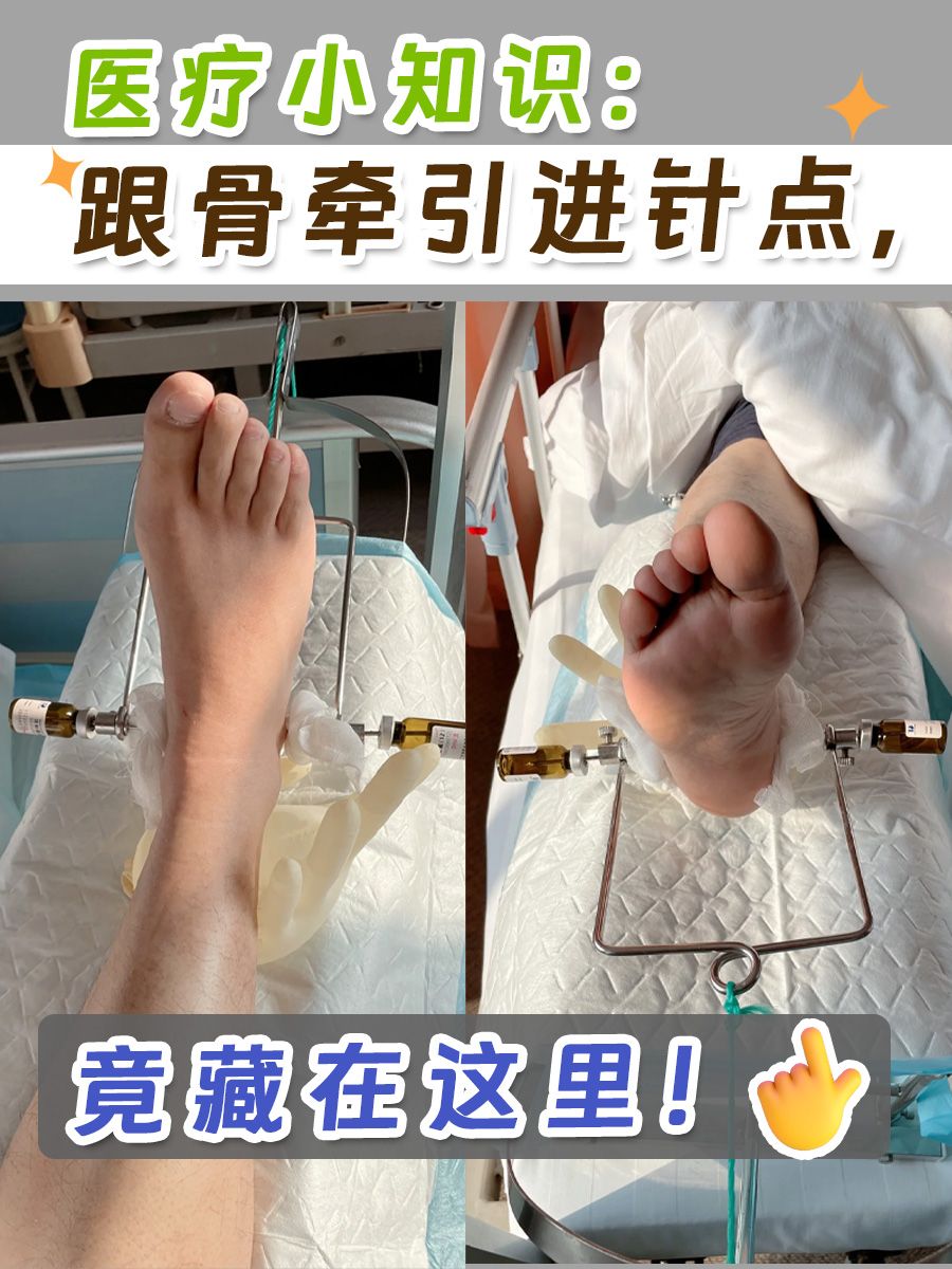 医疗小知识：跟骨牵引进针点，竟藏在这里！