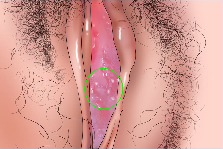 外阴溃疡会阴部手绘图