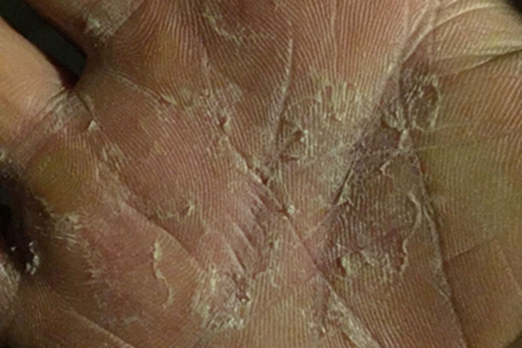 皲裂性湿疹手掌心干燥脱皮图 皲裂性湿疹手掌心干燥脱皮图