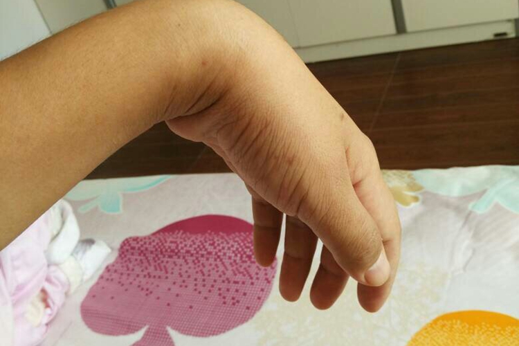 桡神经损伤的手型图