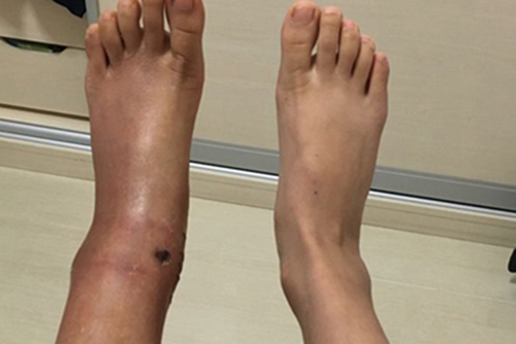 复发性风湿病脚踝肿图 复发性风湿病脚踝肿图