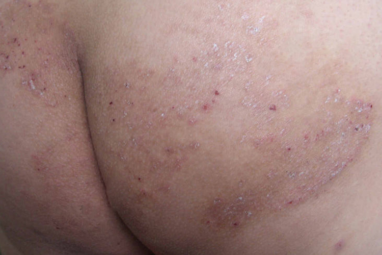 股癣臀部疙瘩图