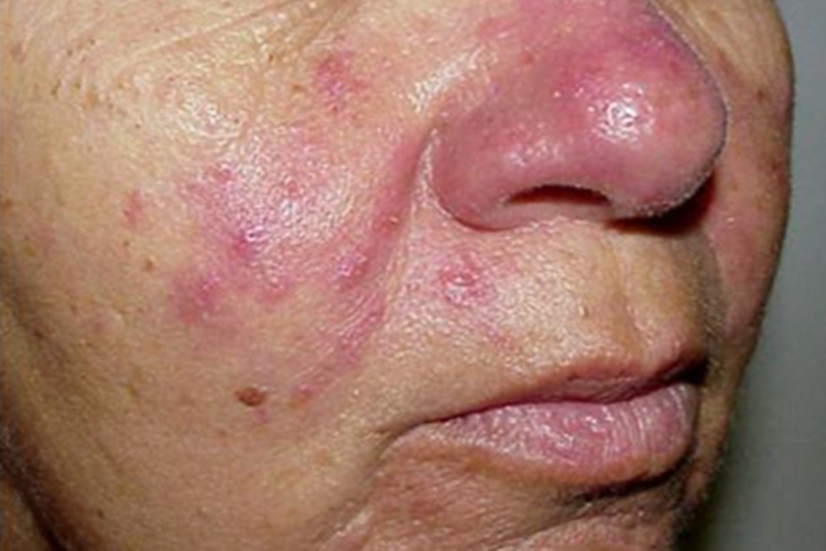 蠕形螨病面部丘疹红斑图