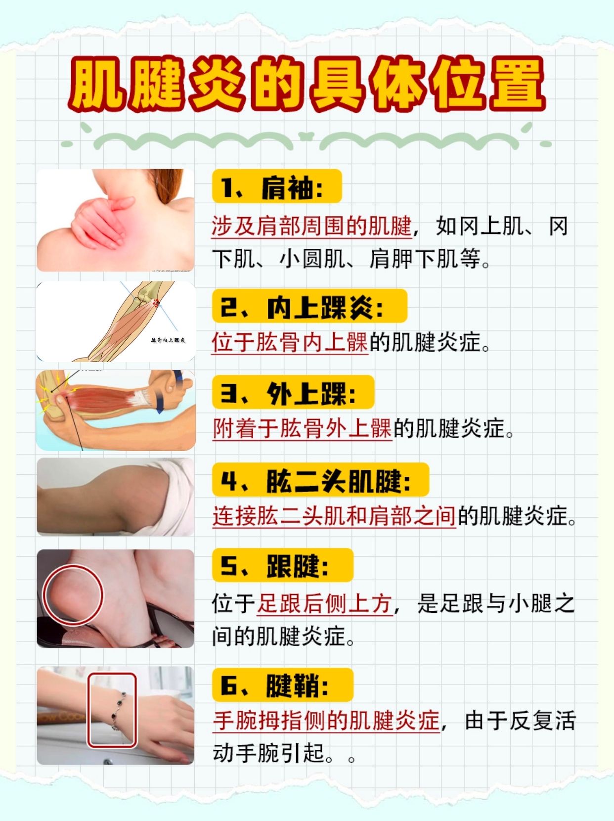 肌腱炎是指哪个部位，你知道吗？