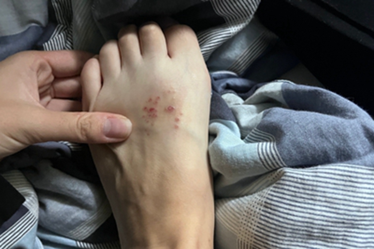 单纯疱疹脚部症状图 单纯疱疹脚部症状图