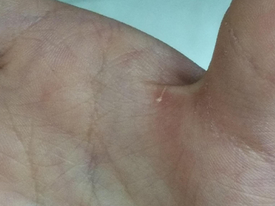 刺伤木屑刺进手部虎口导致轻度红肿图.jpg