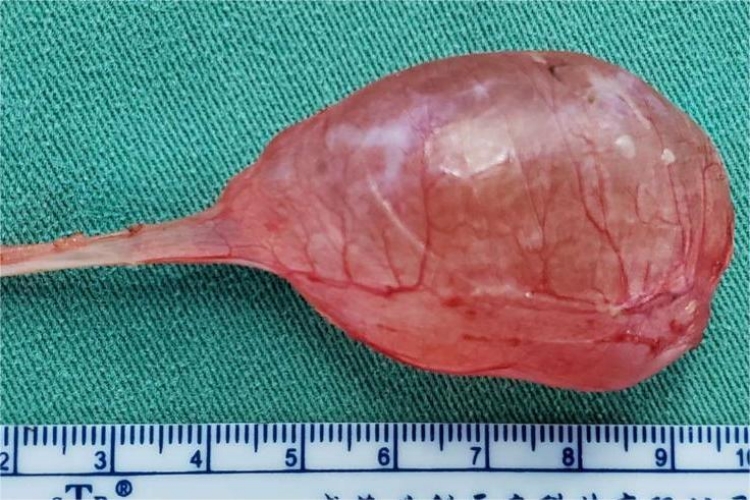 精索囊肿取出图 精索囊肿取出图