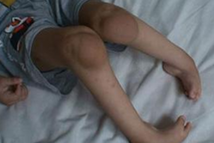 粘多糖病小孩Ⅱ型进行性痉挛图 粘多糖病小孩Ⅱ型进行性痉挛图