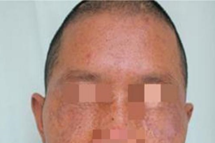 慢性移植物抗宿主病面部斑图 慢性移植物抗宿主病面部斑图