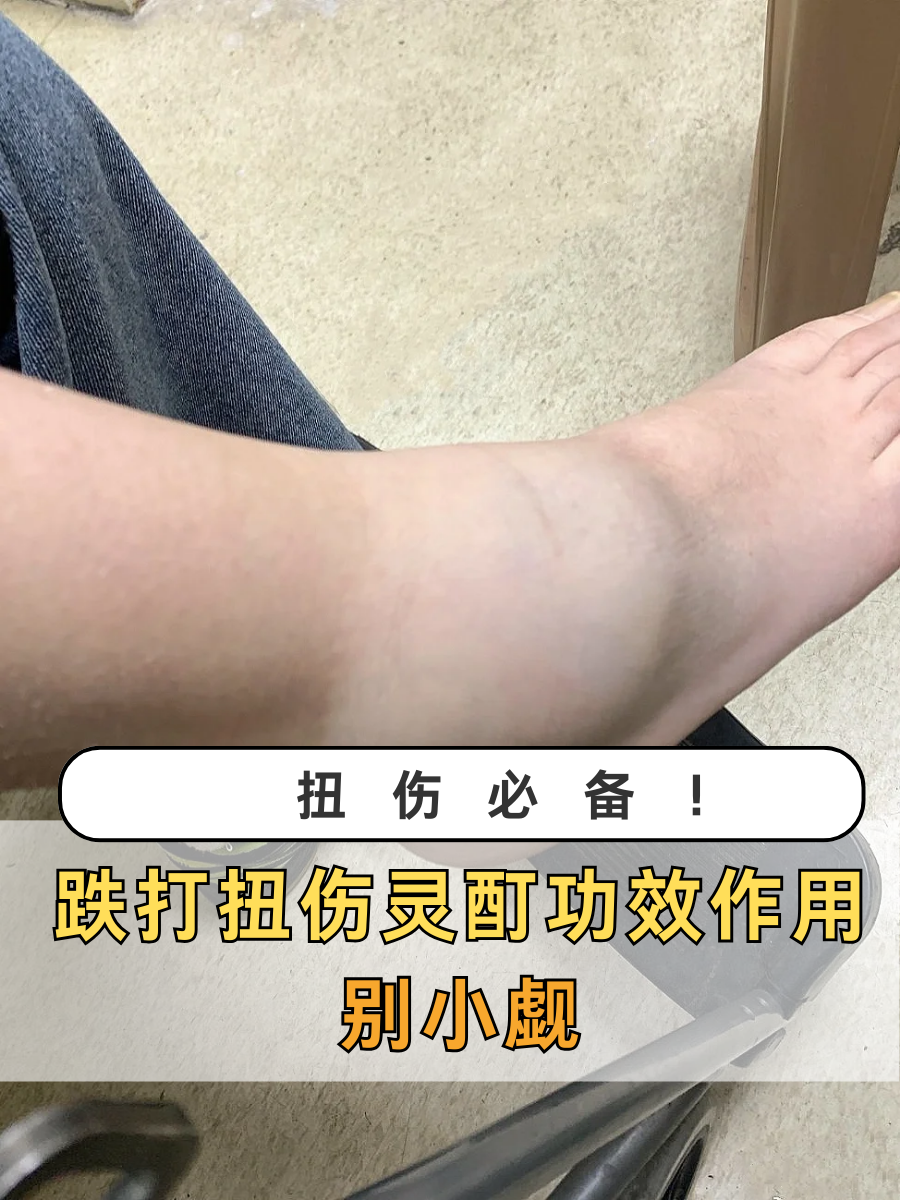 扭伤必备！跌打扭伤灵酊功效作用别小觑