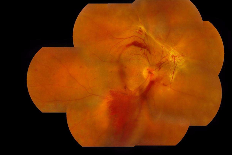 小孩玻璃体积血图