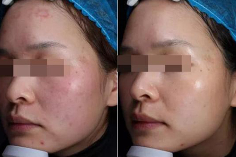 光子嫩肤4次祛雀斑效果图