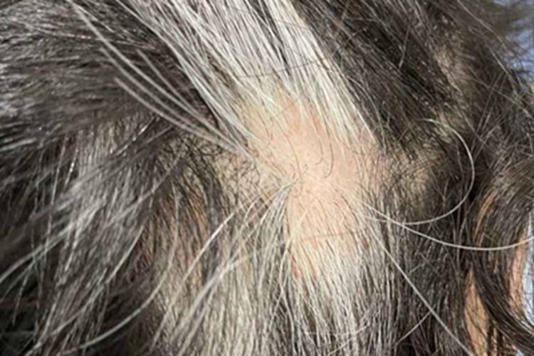 白癜风头发症状图