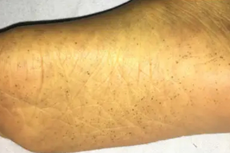 黄疸脚底发黄图