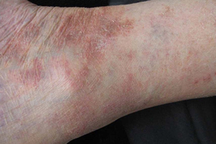 色素苔藓性紫癜样皮炎脚踝红斑图 色素苔藓性紫癜样皮炎脚踝红斑图