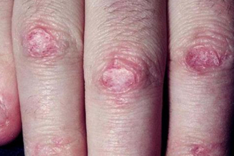 皮肌炎手背症状图