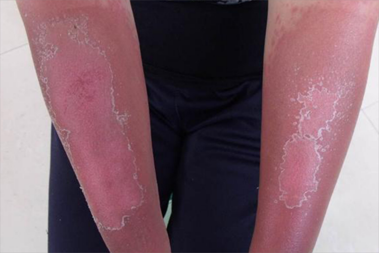 皮肤晒脱皮图片_有来医生