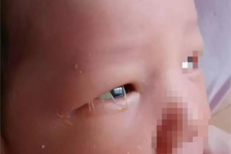 急性泪腺炎症状图