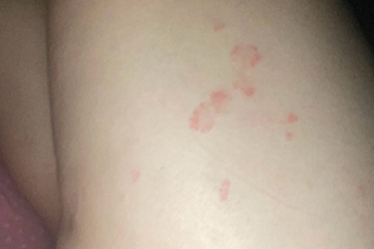 玫瑰糠疹大腿红斑图