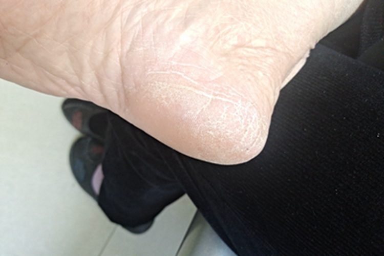 鳞屑角化型足癣脚后跟粗糙图