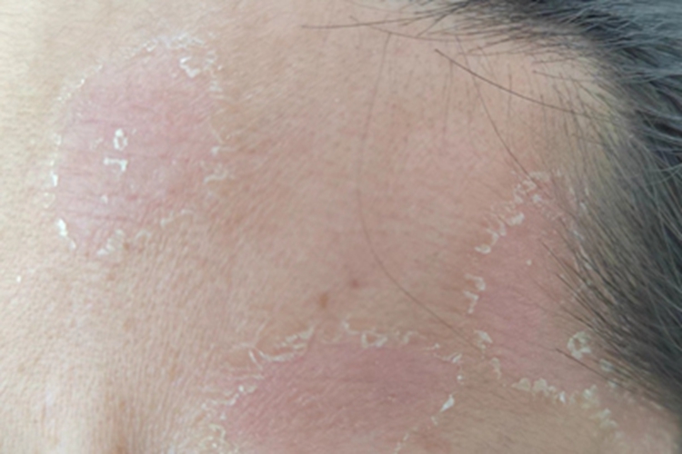 颜面再发性皮炎前额红斑图