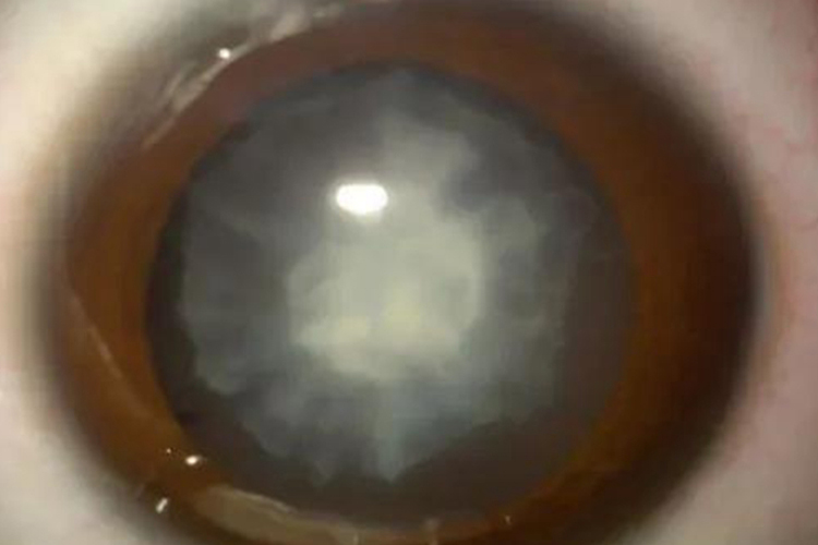 皮质性白内障膨胀期图