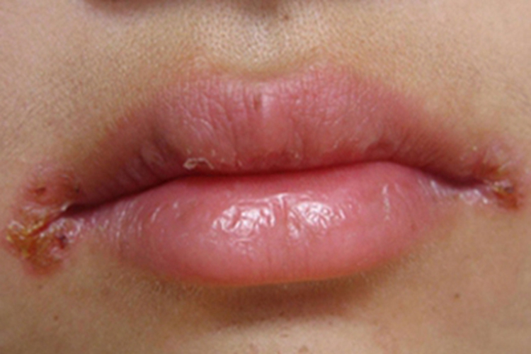 感染性口角唇炎症状图