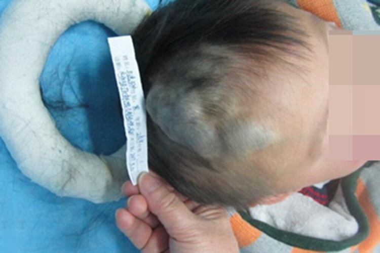 静脉畸形头部皮肤发青图