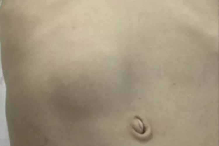 肝包虫病右上腹肿块图