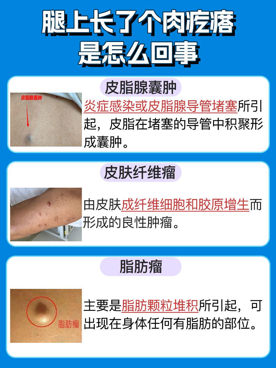 腿上长了个肉疙瘩？一篇文章带你了解全部