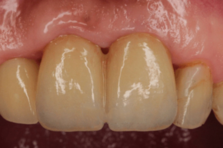 外源性色素沉着异常牙齿变黄图