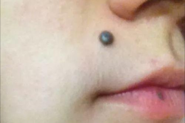 细胞蓝痣口周症状图