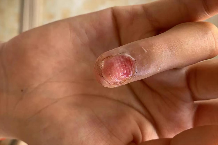 手指拔甲后渗血图