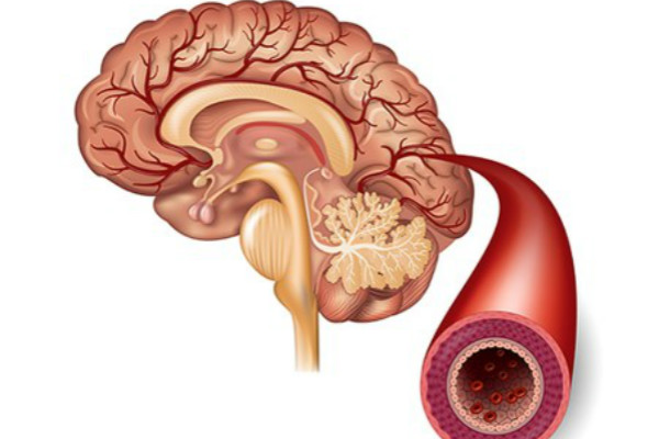 脑血管痉挛1.jpg