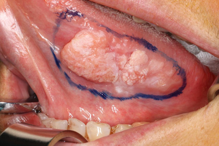 舌癌晚期的图片和症状图片