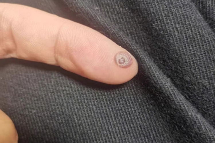 寻常疣手指尖小疙瘩图 寻常疣手指尖小疙瘩图