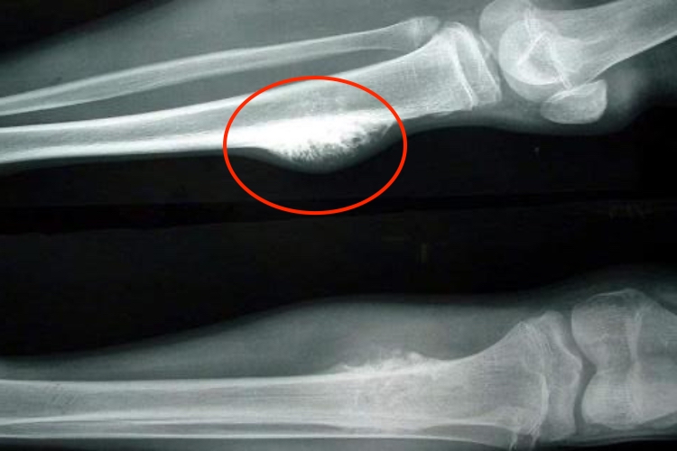 骨癌的早期小肿块图